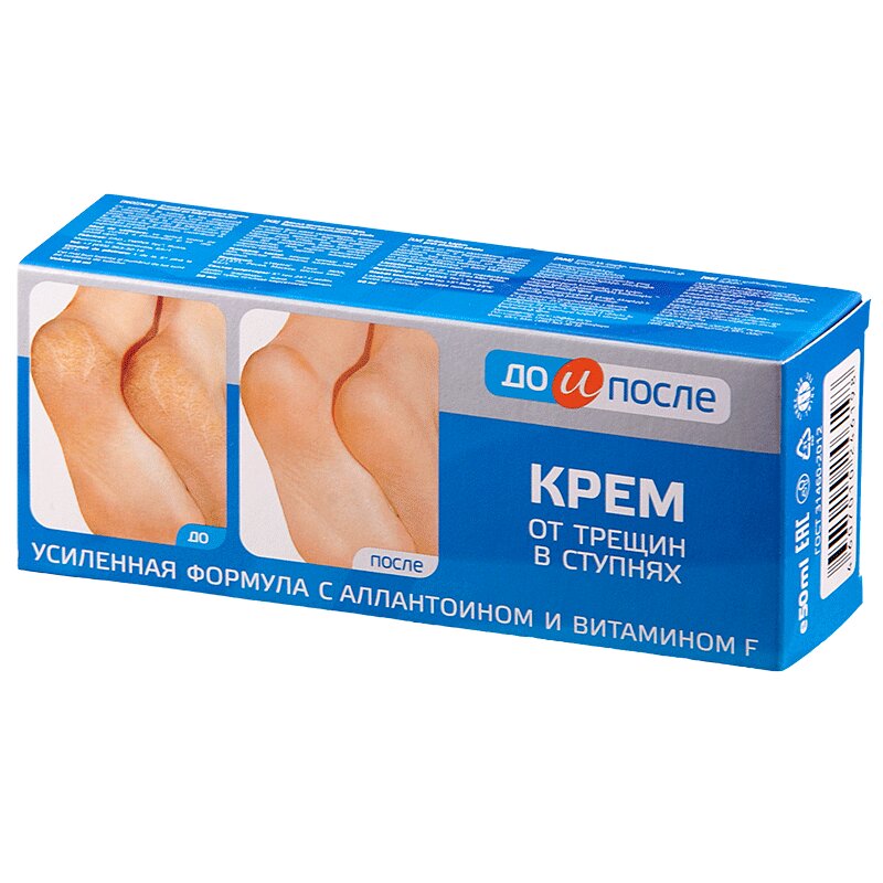 крем для ног от трещин в ступнях. до и после крем от трещин в ступнях 50мл твинс. крем для ног от трещин в ступнях, "до и после", 150 мл. крем для ног от трещин в ступнях «до и после», 50 мл. крем для ног от трещин в ступнях.